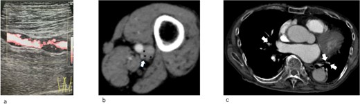 (a) Duplex ultrasonography image of the left superficial vein on admission. A thrombus is observed in the vein. (b) Enhanced computed tomography on admission. Left popliteal venous aneurysm (arrow). A thrombus is observed in the aneurysm (*). (c) Enhanced computed tomography on admission. A pulmonary embolism is observed (arrow)