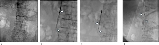 Intraoperative radiographic fluorescence imaging. (a) Pre-deployment venogram of the inferior vena cava (IVC) demonstrating appropriate positioning of the delivery sheath within the IVC prior to inferior vena cava filter (IVCF) placement. (b) The IVCF is not open, and the legs of the IVCF are folded. The IVCF is hung on a plunger. The arrow indicates the tip of the sheath. The arrowheads indicate the folded IVCF legs. (c) The IVCF could not be retrieved because it is detached from the plunger. The arrow indicates the tip of the sheath. The arrowheads indicate the folded IVCF legs. (d) The new IVCF is deployed proximal to the old IVCF.