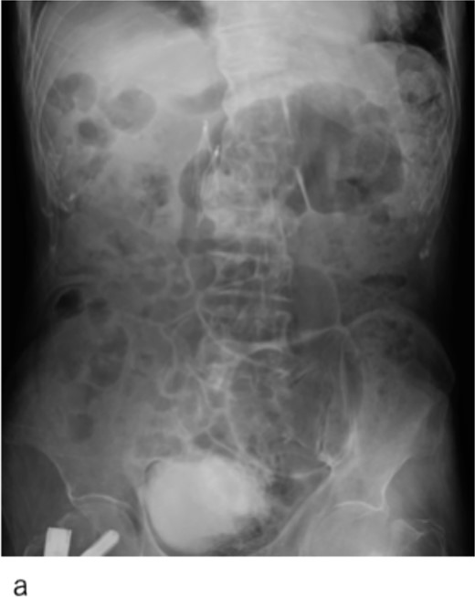 Abdominal X-ray image after the surgery. Two inferior vena cava filters are placed.