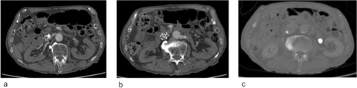 Computed tomography images 14 days after surgery. (a,b) The IVCF is still folded and not open. (c) Legs of IVCF are still folded.