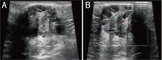 Ultrasound: (A) 2D ultrasound shows a mixed echo with a range of about 4 cm in the subcutaneous soft tissue around the left side of the anus, presenting as cystic-solid; (B) color doppler shows a small amount of punctate blood flow signal inside and around the mixed echo.