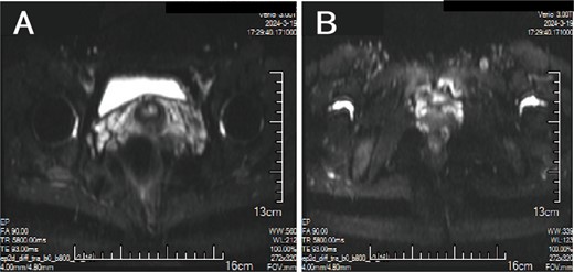 MRI: (A, B) A cluster of low/high mixed signals such as T1 and T2 can be seen on the left side of the anus, and the DWI signal is partially increased.