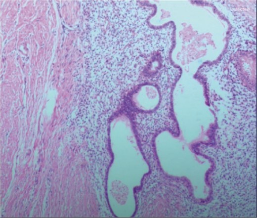 Postoperative pathology: the endometrial glands have typical stroma, blood, and macrophages containing hemosiderin.