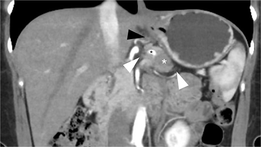 Preoperative CT scan (coronal view, portal phase) shows a 25 mm spiculated mass with hypoattenuation observed after the administration of IV contrast (white asterisk). The lesion encases the splenic artery (black asterisk), extends to the retroperitoneal fat (white arrowhead), and shows mesogastric distortion (black arrowhead).