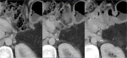 CT scan taken 12 months after surgery, displayed from upper to lower in a left to right sequence, showing the anastomosis between the left gastric vein (LGV, 1) and left adrenal vein (LAV, 2). The left renal vein is indicated by ‘**’.