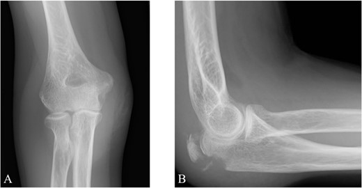 Plain radiographs of the right elbow show no abnormal findings in the anteroposterior view (A); however, an avulsion fracture of the olecranon is observed in the lateral view (B).