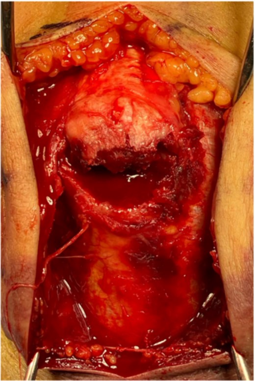 The bone fragment is displaced, and its continuity with the triceps tendon is preserved.