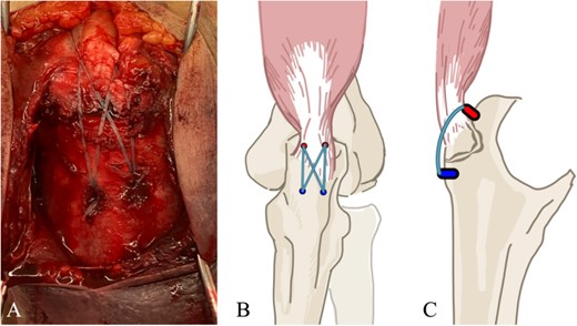 (A) The suture bridge technique is performed using JuggerKnot® All-Suture Anchors and Quattro® Link Knotless anchors. A schematic of the surgical field is shown in (B) frontal and (C) lateral views. Proximal anchors are JuggerKnot® All-Suture Anchors, while distal anchors are Quattro® Link Knotless anchors.