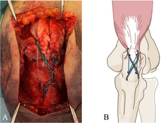 (A) Addition of McLaughlin cerclage using BroadBand® Tape. (B) A schematic of the surgical field is shown. The artificial ligament is fastened in a figure-of-eight configuration.