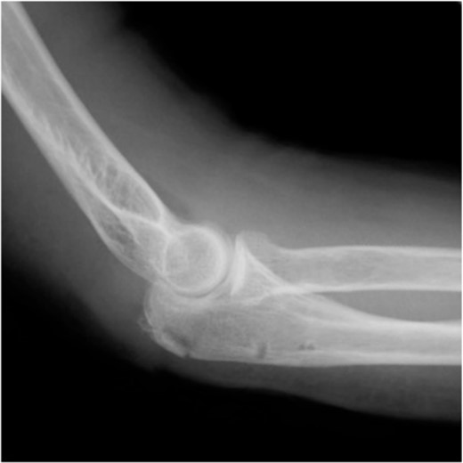 Postoperative lateral elbow radiographs. The bone fragment is reduced and fixed.