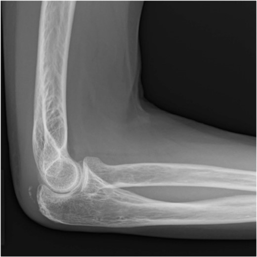 At 4 months after the surgery, the X-ray shows complete bone union in the lateral view.
