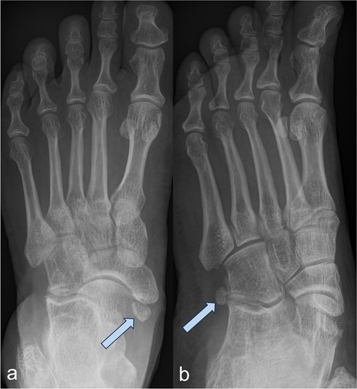 Image of an Os tibiale externum Type II in the anterior–posterior (a) and oblique (b) radiographic view; the ossicle is marked with an arrow.