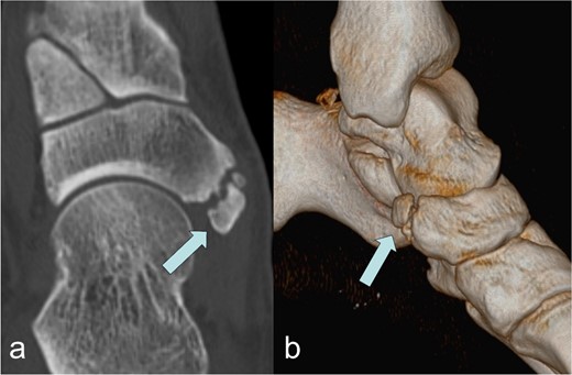 Image of the Os tibiale externum Type II in the coronal reformatted CT scan (a) and in the 3D representation (b); the ossicle is marked with an arrow.