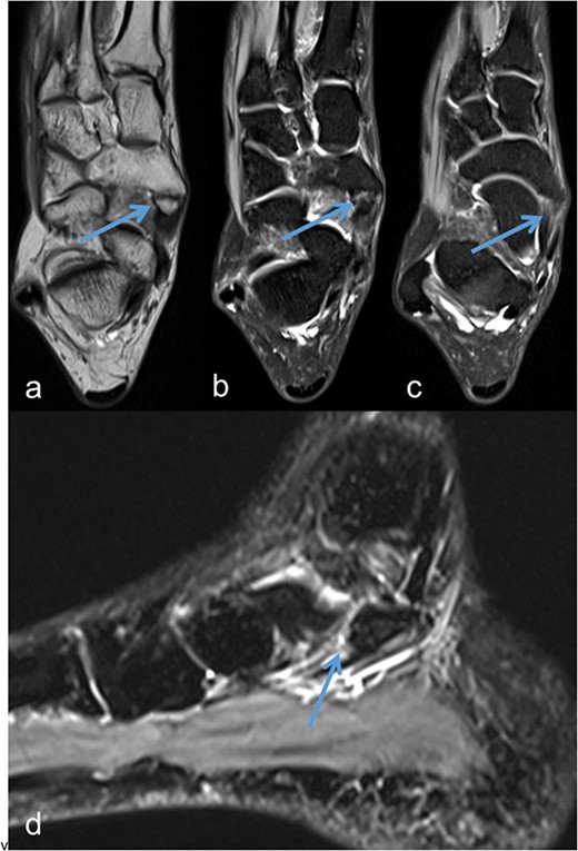 Os tibiale externum Type II in the coronal T1-weighted MRI scan (a), inflammatory reaction/tendinosis at the insertion of the tendon of the tibialis posterior muscle visualized in the heavily T2-weighted, fat-suppressed MRI scans (b and c), synchondrosis between the Os tibiale externum Type II and Os naviculare with central and perifocal edema visualized in the sagittal heavily T2-weighted, fat-suppressed MRI scan (d); each marked with an arrow.