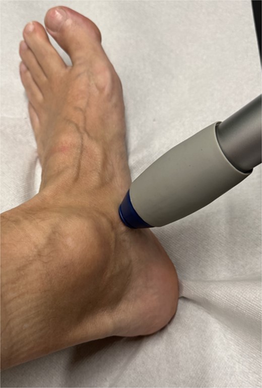 Illustration of the technical implementation of extracorporeal shockwave therapy.