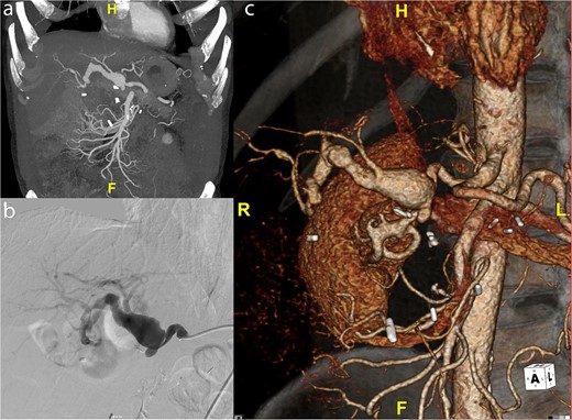(a) Preoperative CT scan of hepatic artery aneurysm postremote pancreaticoduodenectomy. (b) Catheter-based angiogram of hepatic aneurysm. (c) 3-D reconstruction of hepatic artery aneurysm.