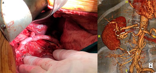 (a) Intraoperative picture of completed saphenous vein bypass to left and right hepatic arteries. (b) One-year postoperative CT scan of patent hepatic artery bypass.