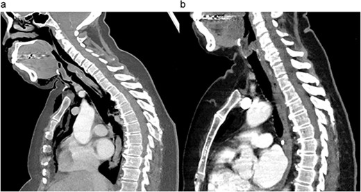 Preoperative (a) and postoperative (b) sagittal CT views of the thoracic cavity, demonstrating a large posterior tracheal defect extending to just above the carina, and its resolution postoperatively.