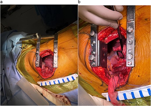 (a) Right posterolateral thoracotomy for operative exposure. (b) Primary closure of posterior tracheal laceration.