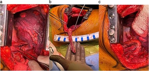 (a) Closure of paratracheal soft tissue. (b) Intercostal flap obtained. (c) Reinforcement of the tracheal repair with the intercostal flap.