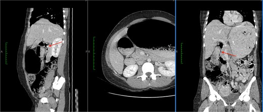 CT images showed a massively dilated stomach and duodenal cap with a point of obstruction distal to D1 of duodenum (thin arrows). No obstructing lesion was identified.