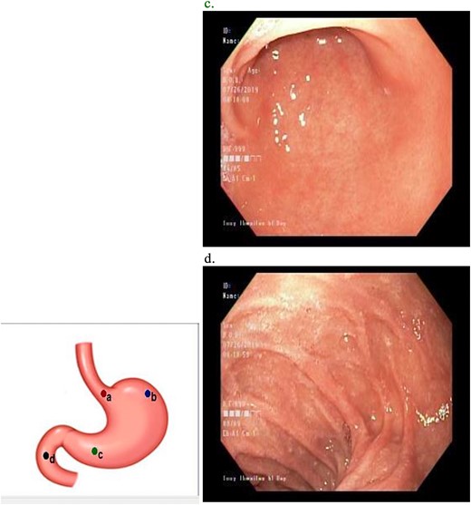Upper GI endoscopy revealed mild antral gastritis. The duodenum was intubated and had normal mucosa.