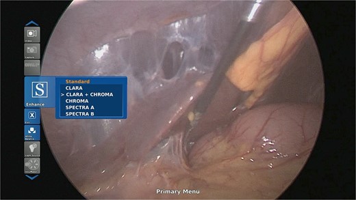 Extensive supra- and subhepatic adhesions were noted at laparoscopy.