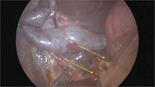 The gallbladder was dissected free of the dense adhesions. There was no evidence of previous cholecystitis. The stomach (short arrow) was spared of adhesions, but the first and second parts of the duodenum were encased (long arrows).