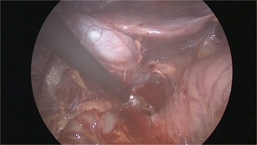 Duodenal adhesions lysed.