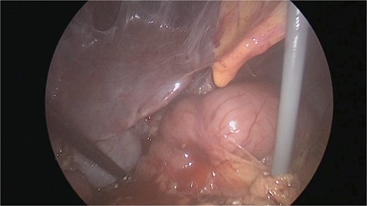 Kockerized D1 and D2 of duodenum.