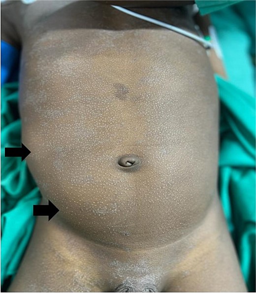 Black arrows show asymmetrical abdominal distension on the right lumber and iliac regions.
