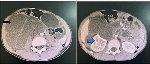 A contrasted preoperative abdominal pelvic computed tomography Image with IV contrast. The black arrow shows an intraabdominal multiseptated fluid cyst. The blue arrow shows hydronephrosis of the right kidney as the result of the pressure effect of the mass.