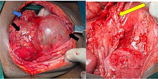 Intraoperative image, black arrow shows a mass after reflection of the adherent bowels from the tumor. Blue arrow showing a right kidney with hydronephrosis. The yellow arrow shows a dilated ureter post cyst excision.