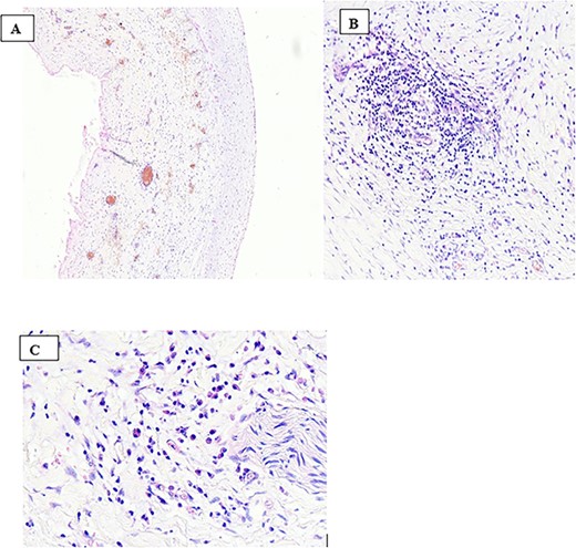 Histological sections from the cyst (haematoxylin and eosin stain ×100 (A), ×200 (B) and ×400 (C), respectively) showing the absence of the lining epithelium with a wall of the lesion composed of fibrous tissue and congested blood vessels, edema and aggregates of mononuclear inflammatory cells (A). These inflammatory cells were predominantly lymphoplasmacytic infiltrates (B and C) with no features of malignancy, granulomas, or necrosis.