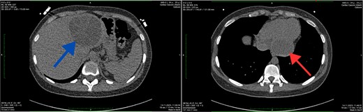 Axial CT scan showing the cystic lesion in the left lobe of the liver (blue arrow) and axial CT scan showing the cystic lesion in the left ventricle (red arrow).
