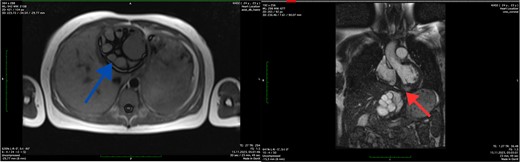 Axial MRI scan of the liver (blue arrow) and coronal MRI scan of the left ventricle (red arrow) showing the cystic lesions.