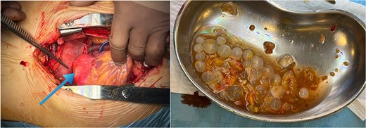 Perioperative image of cardiac hydatid disease showing the cystic lesion in the left ventricle (blue arrow) and ruptured hydatid cysts with undamaged daughter cysts.