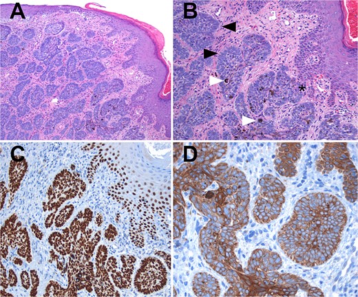 Hematoxylin and eosin (H&E) staining. (A) Display of normal stratified flat epithelium of the skin with a subjacent neoplasm featuring small nests. (B) Higher magnification reveals the tumor arising from the basal layer of the skin (*). The nests exhibit characteristic peripheral nuclear palisading (black arrows), and both melanin pigment and melanocytes are visible (white arrows). (C) Both the tumor and adjacent skin cells exhibit strong nuclear positivity for p63. (D) Tumor cells demonstrate strong positivity for high molecular weight cytokeratins (CK5/6).