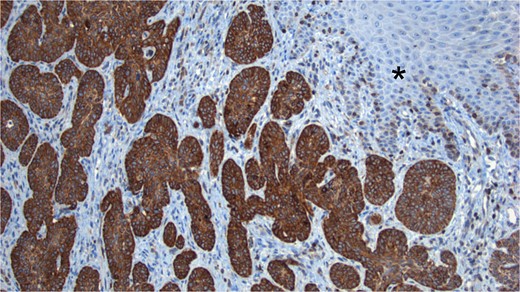 BCL2 Staining. Tumor cells show intense positivity for BCL2, contrasting with the negativity observed in the normal skin (*).
