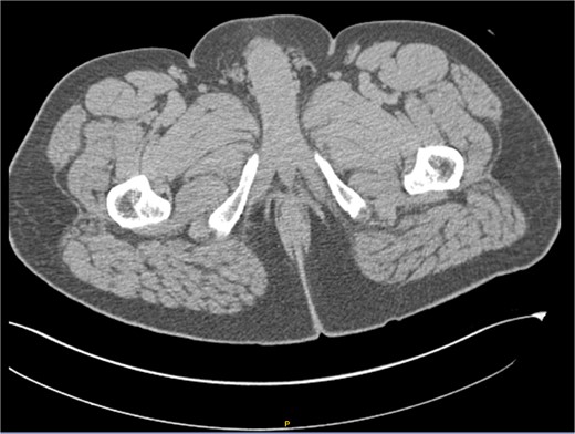 Computed tomography (CT) scan with intravenous contrast (IV). Hepatic cystic lesions, with diameters of up to 5 mm, which did not enhance with contrast. Additionally, it was observed that the perianal region showed no fat stranding or increased volume, and no lymphadenopathy was detected.