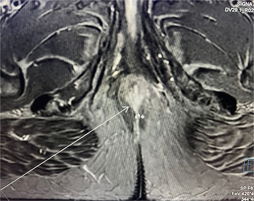 Abdominal and pelvic magnetic resonance imaging. The white arrow points to a 16 x 22 mm mass in the perianal region, where asymmetric thickening affecting both the external and internal sphincters is evident, located just at the anodermic junction and extending into the levator ani muscles.
