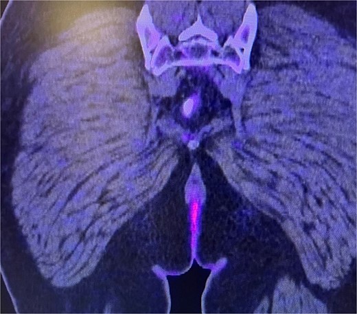 Abdominal and pelvic PET-CT, coronal section. Image showing perianal region without uptake and absence of adenopathy.