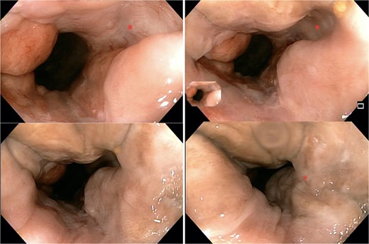 Colonoscopy findings. Image showing a flat white scar, telangiectasia, and absence of both ulcer and nodularity.