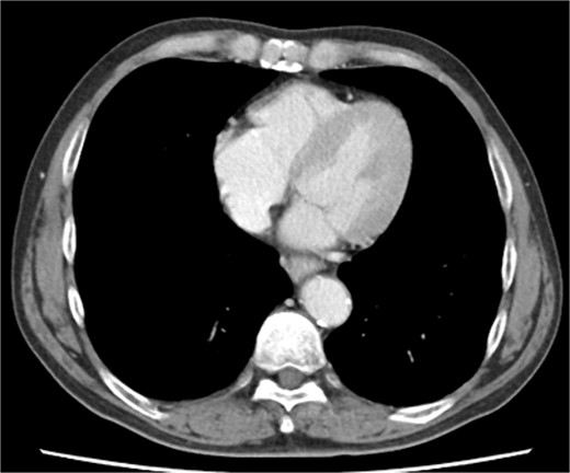 Preoperative contrast-enhanced computed tomography shows no evidence of pericardial effusion, or significant coronary aneurysm.