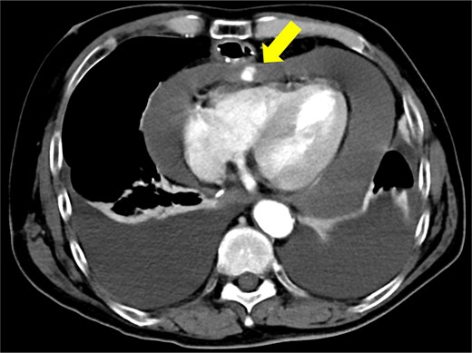 Contrast-enhanced computed tomography shows contrast extravasation in the anterior right ventricle (arrow).