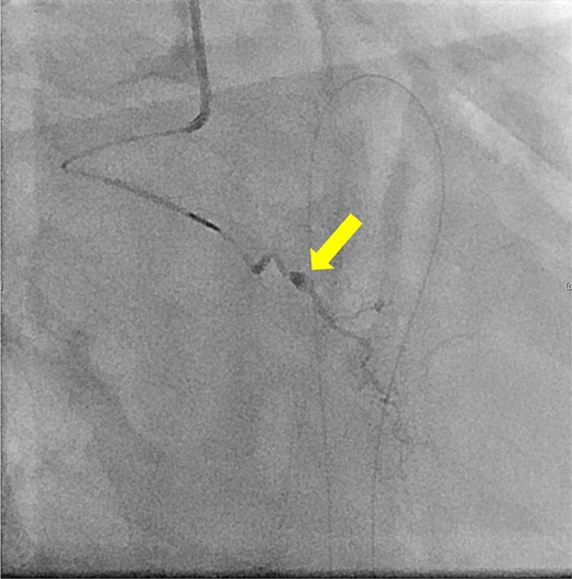 Coronary angiography reveals aneurysmal changes in the right ventricular branch without evident bleeding (arrow).