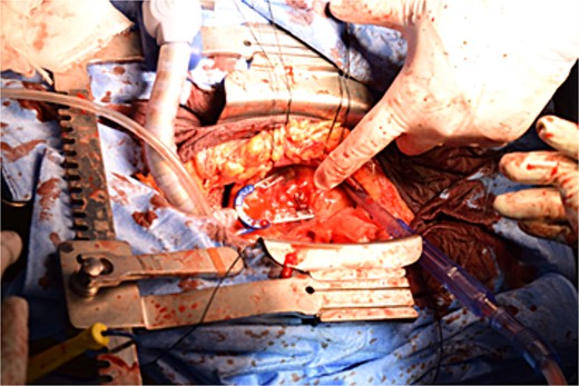 A 5 mm aneurysm in the peripheral right ventricular branch with pulsatile bleeding is observed.