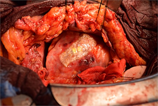 Hemostasis of the coronary artery aneurysm is achieved using horizontal mattress suturing and application of TacoSeal® and Volheal®.
