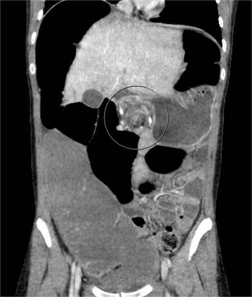 CT of the abdomen performed on Day 1 of admission. Shows colonic distension with volvulus at the splenic flexure.
