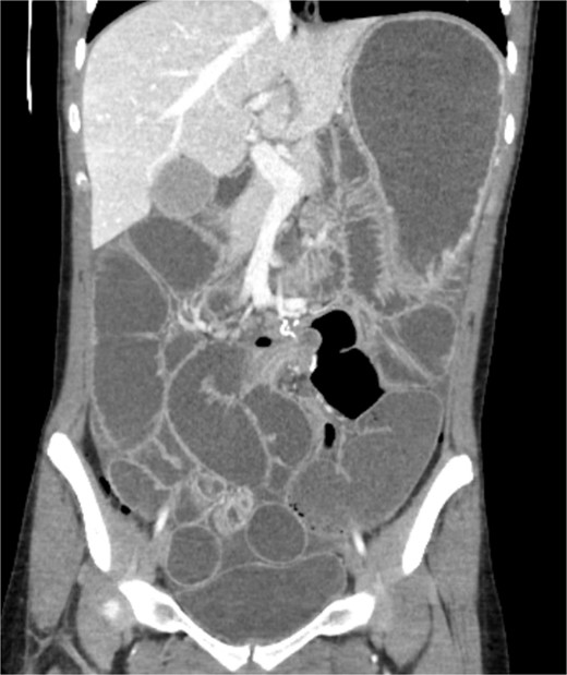 CT of the abdomen performed 8 days post operation. Shows proximal dilatation of the small bowel.